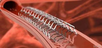 顯影環(huán)去毛刺處理工藝 顯影環(huán)去毛刺處理工藝